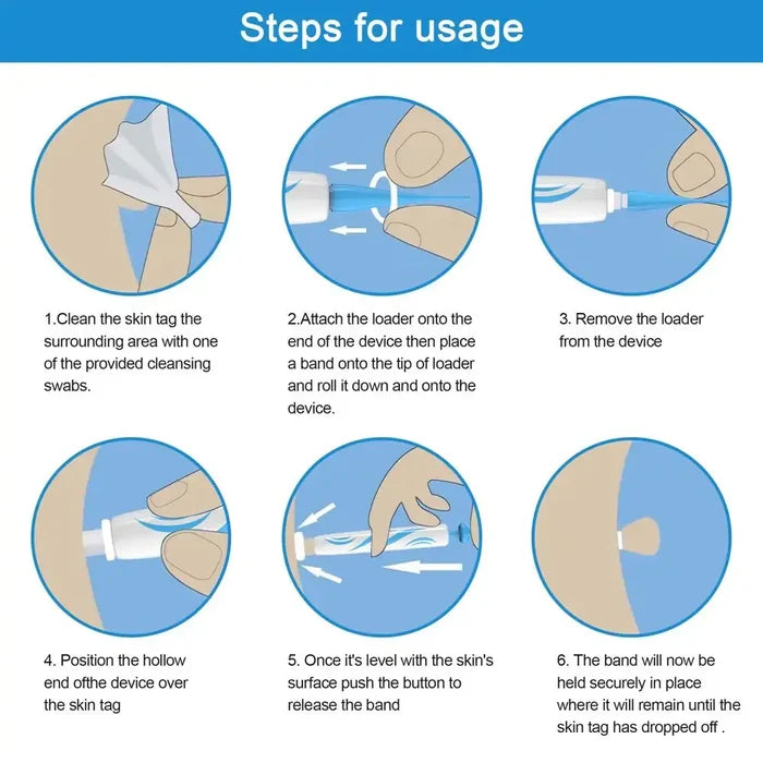 Painless Wart Removal Kit Rieworkes